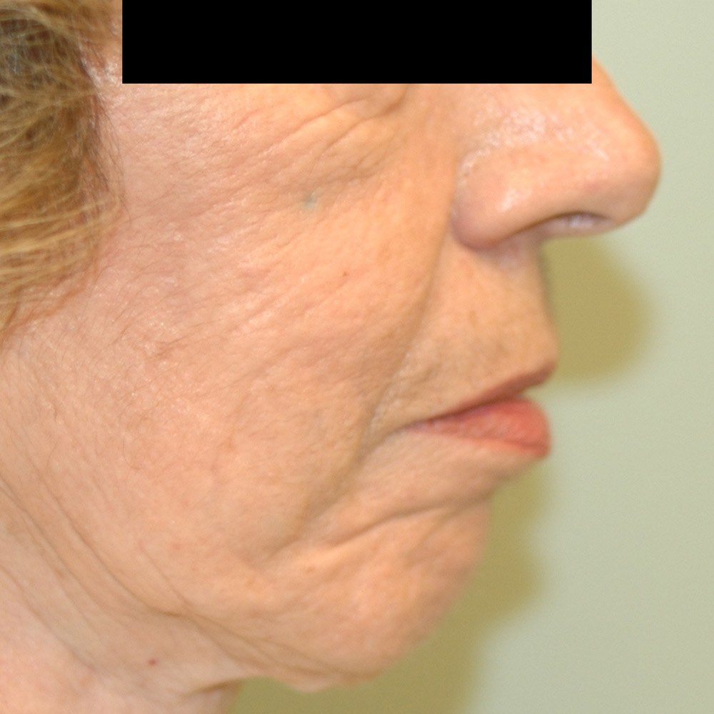 7416 Before Fat Grafting - Lake Oswego and Portland, Oregon