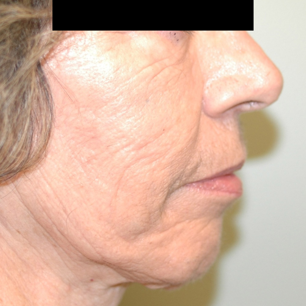 7416 After Fat Grafting - Lake Oswego and Portland, Oregon