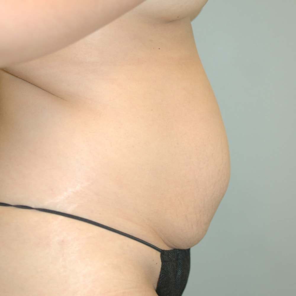 4953 Right View Before Mommy Makeover Surgery in Lake Oswego & Portland, OR