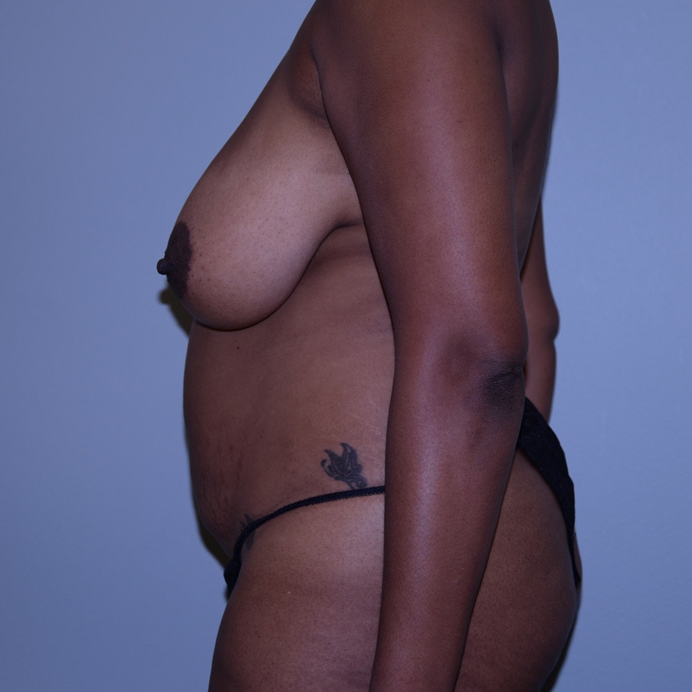 5526 Left View Before Mommy Makeover Surgery in Lake Oswego & Portland, OR