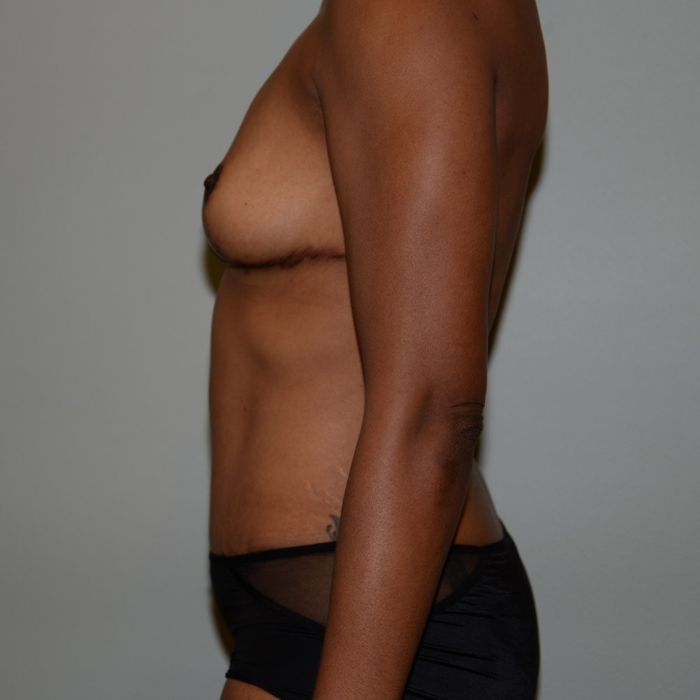 5526 Left View After Mommy Makeover Surgery in Lake Oswego & Portland, OR