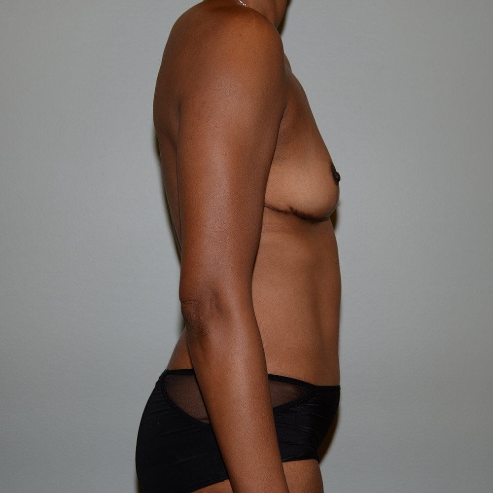 5526 Right View After Mommy Makeover Surgery in Lake Oswego & Portland, OR