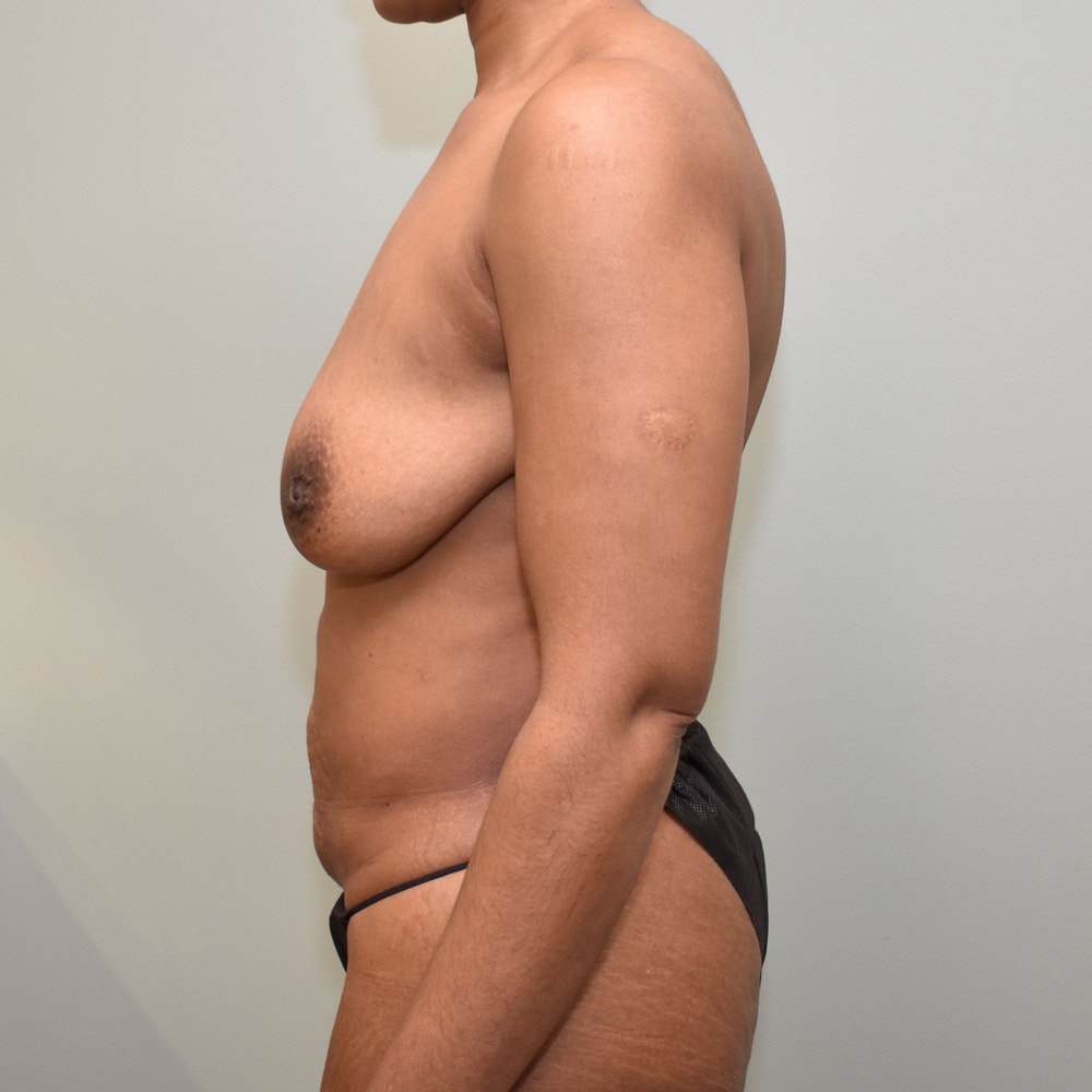 7845 Left View Before Mommy Makeover Surgery in Lake Oswego & Portland, OR