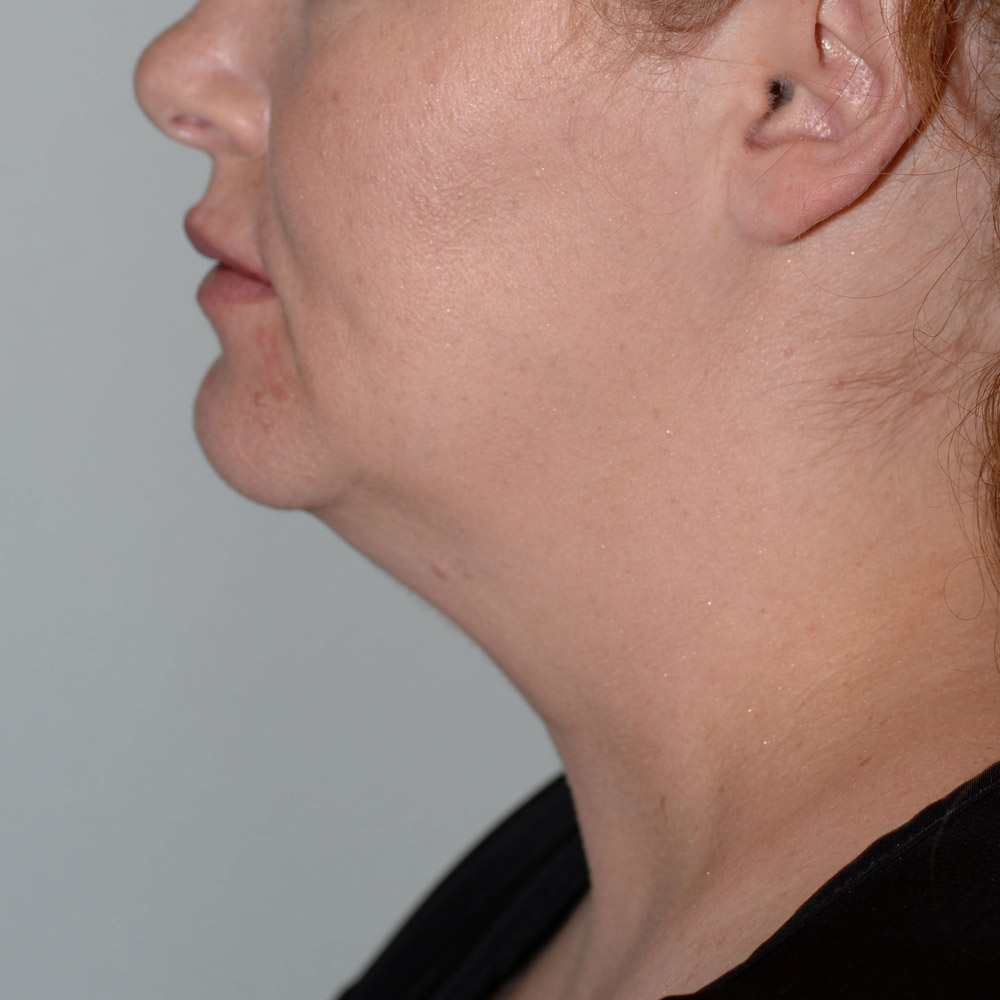 5378 Before Neck Liposuction - Lake Oswego and Portland, Oregon