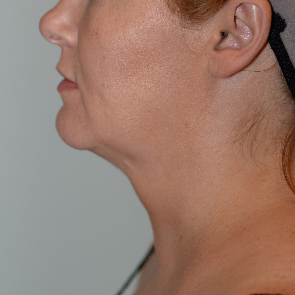 5378 After Neck Liposuction - Lake Oswego and Portland, Oregon