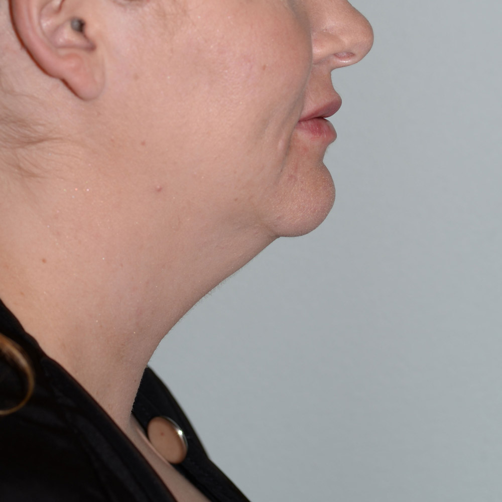 5378 Before Neck Liposuction - Lake Oswego and Portland, Oregon