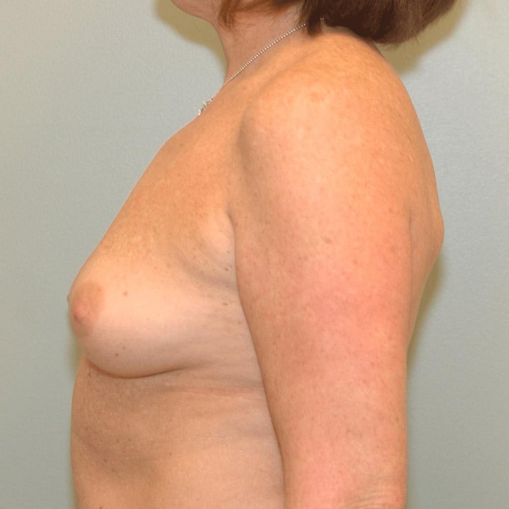 Case--2010 | Before Breast Reconstruction 2