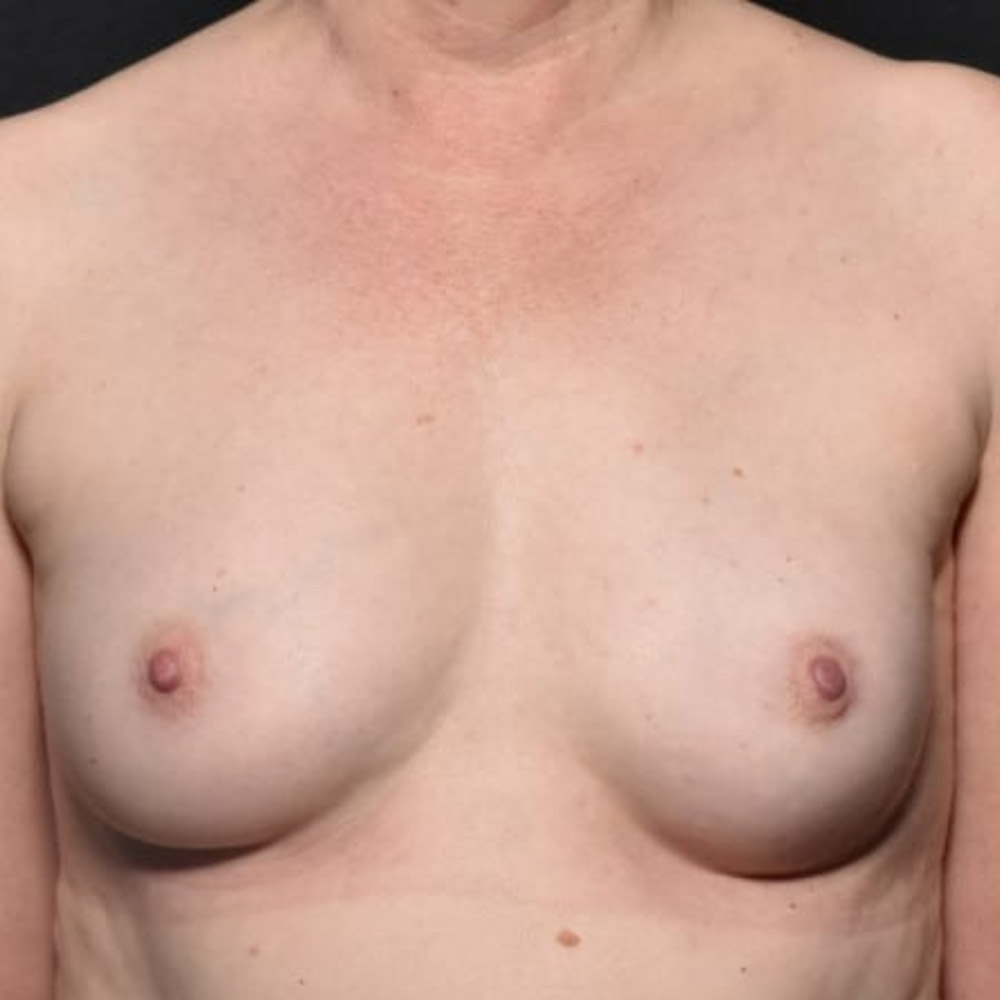 Case--2021 | After Breast