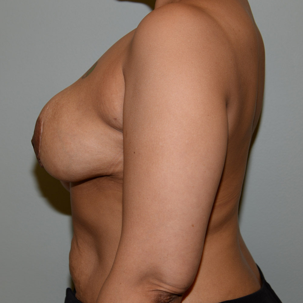 Case--2011 | Before Breast Reconstruction 2