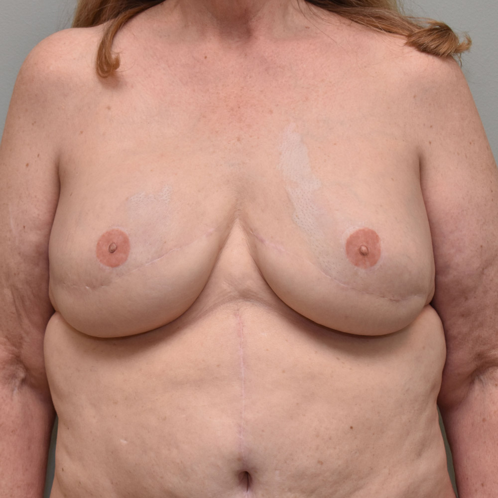 Case--2012 | After Breast