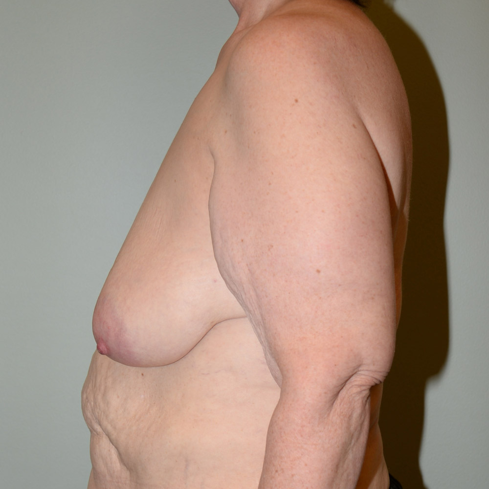 Case--2012 | Before Breast Reconstruction 2