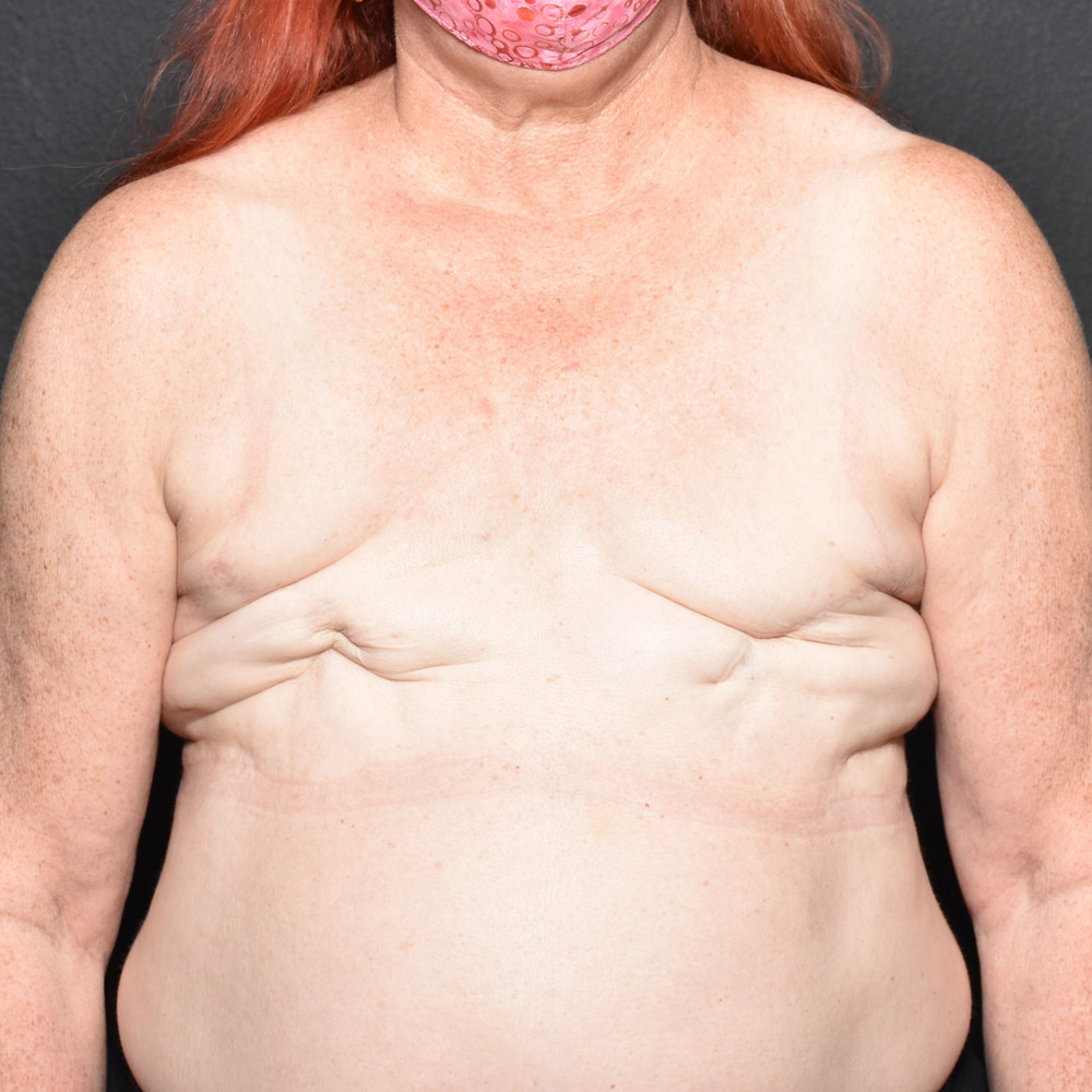 Case--2016 | Before Breast