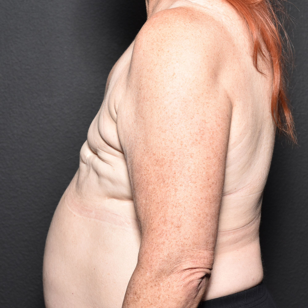 Case--2016 | Before Breast Reconstruction 2