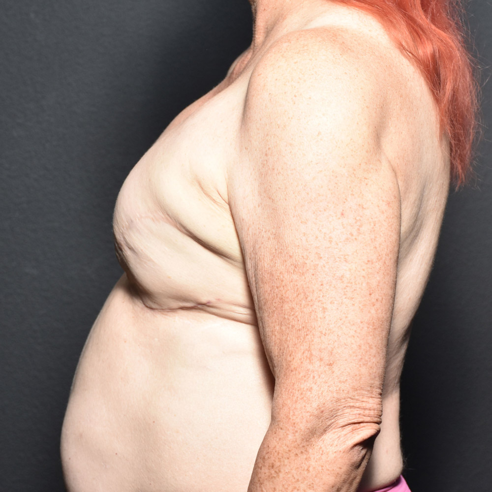 Case--2016 | After Breast Reconstruction 2