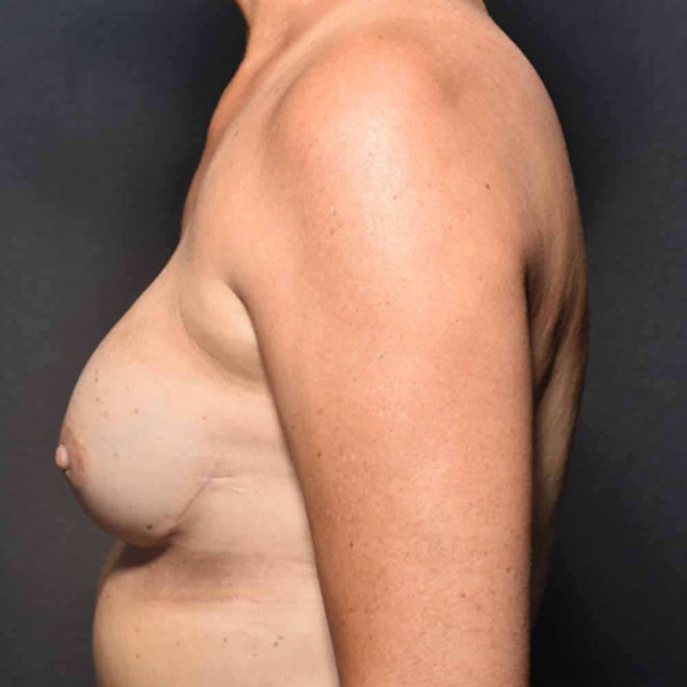 Case--2017 | After Breast Reconstruction 2