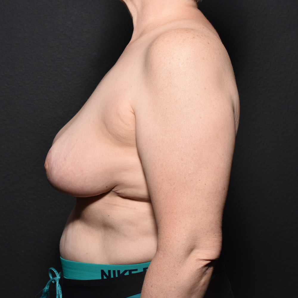 Case--2101 | After Breast Reduction 2