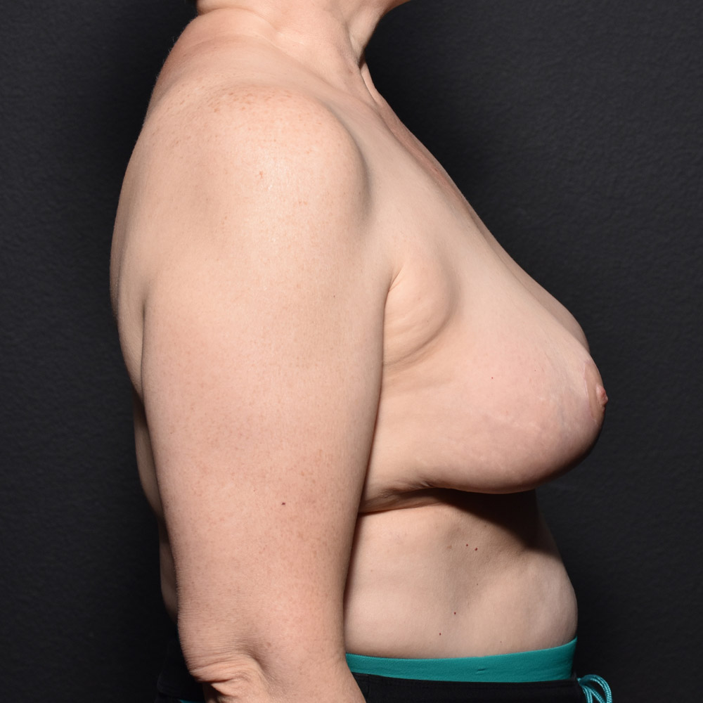 Case--2101 | After Breast Reduction 3