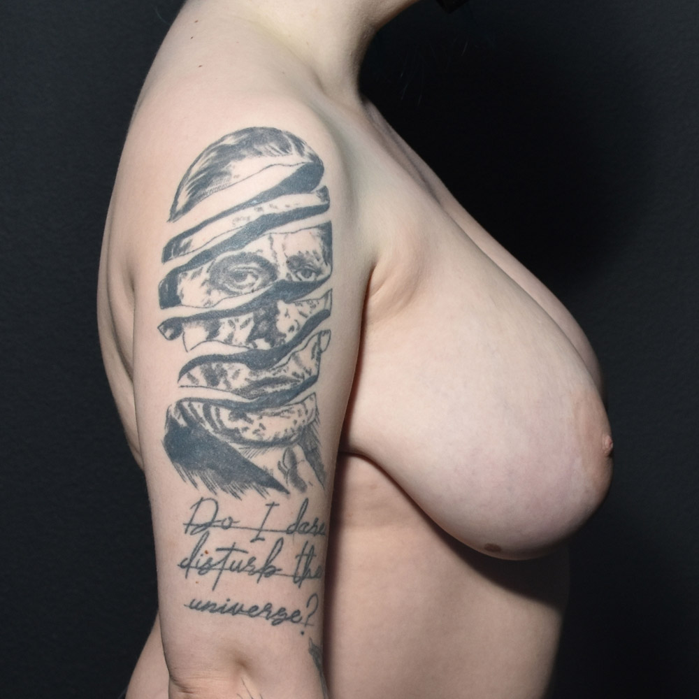 Case--2103 | Before Breast Reduction 3