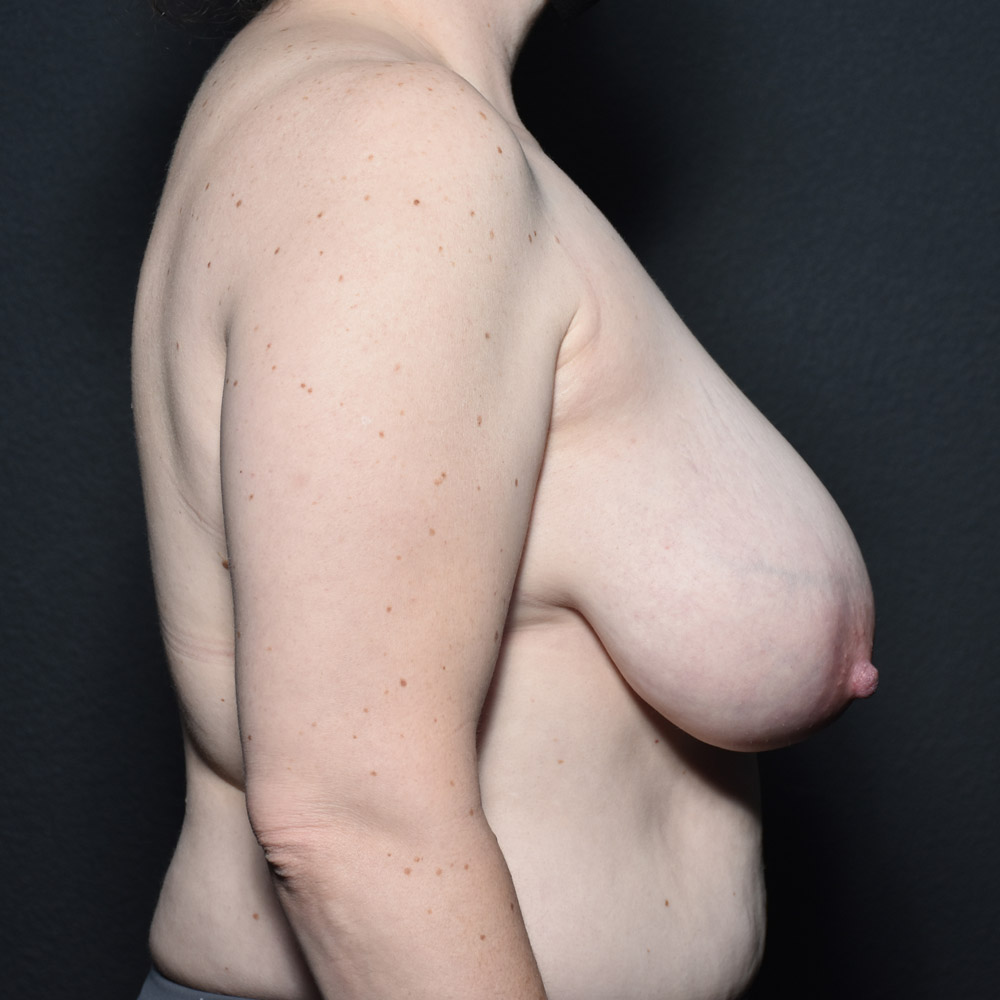 Case--2105 | Before Breast Reduction 3