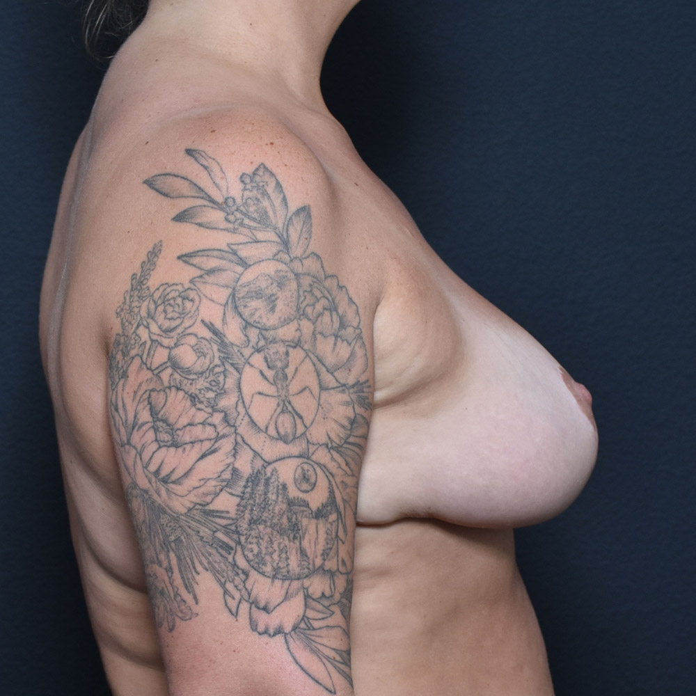 Case--2106 | After Breast Reduction 3