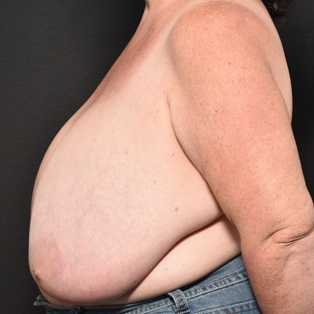 Case--2107 | Before Breast Reduction 2