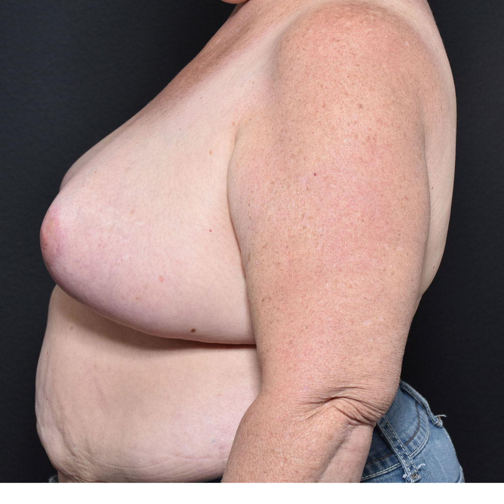Case--2107 | After Breast Reduction 2