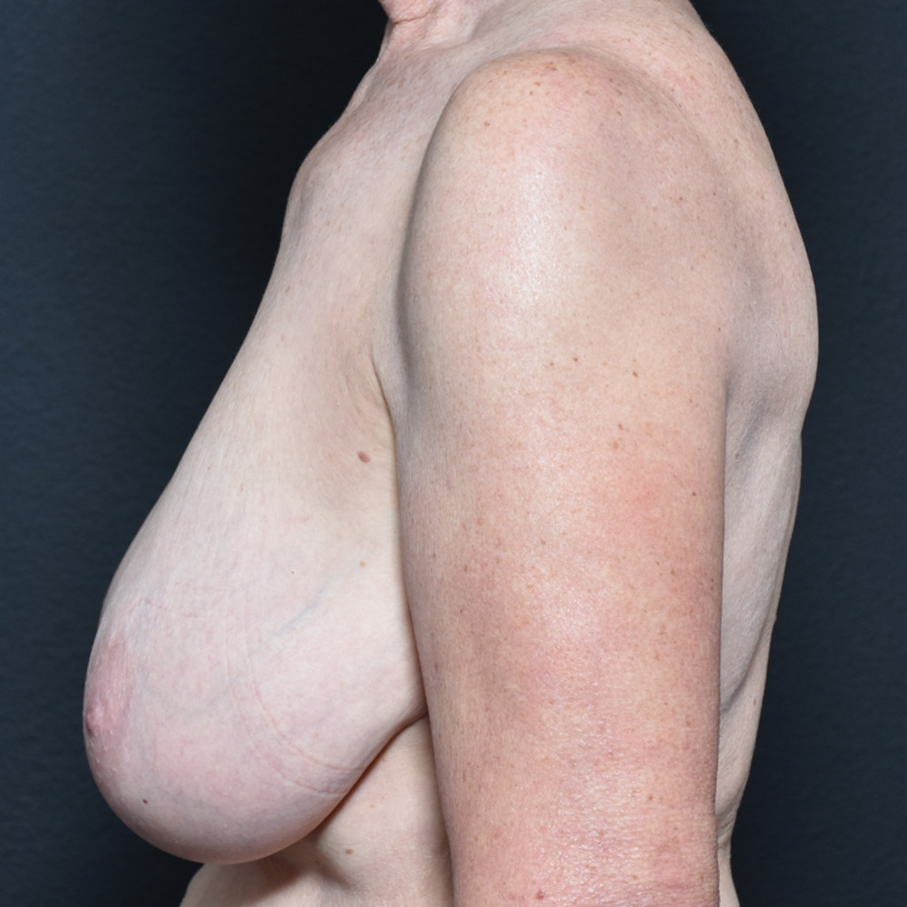 Case--2109 | Before Breast Reduction 2