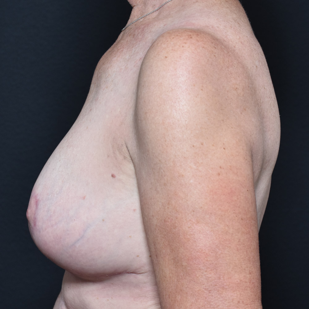 Case--2109 | After Breast Reduction 2