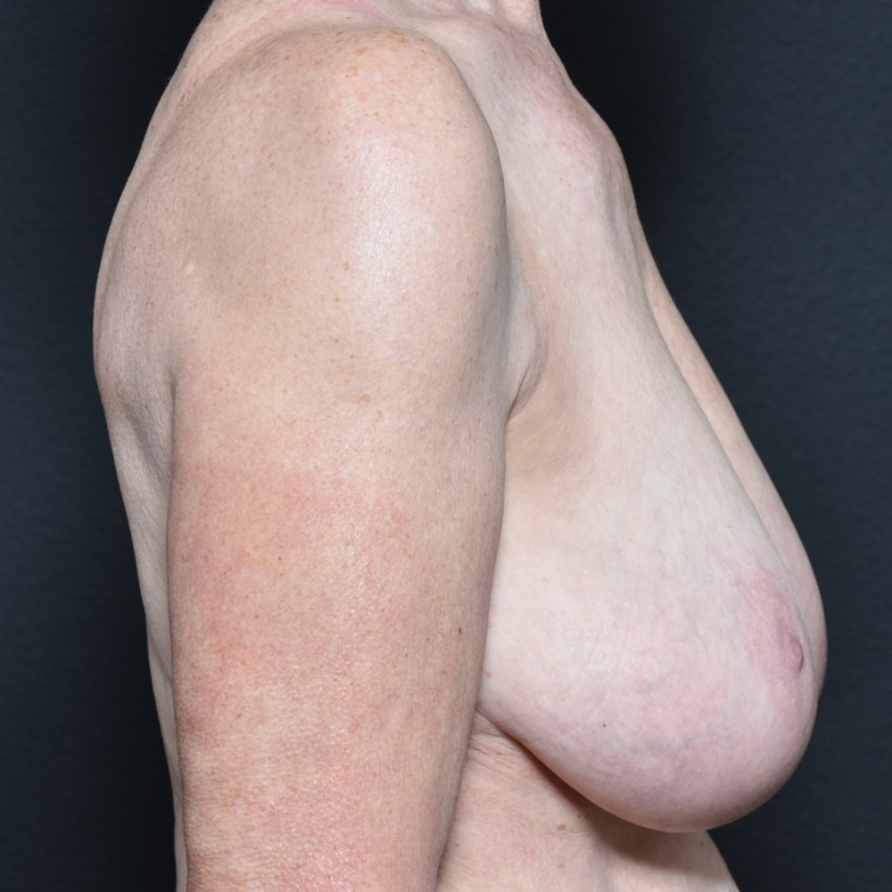 Case--2109 | Before Breast Reduction 4