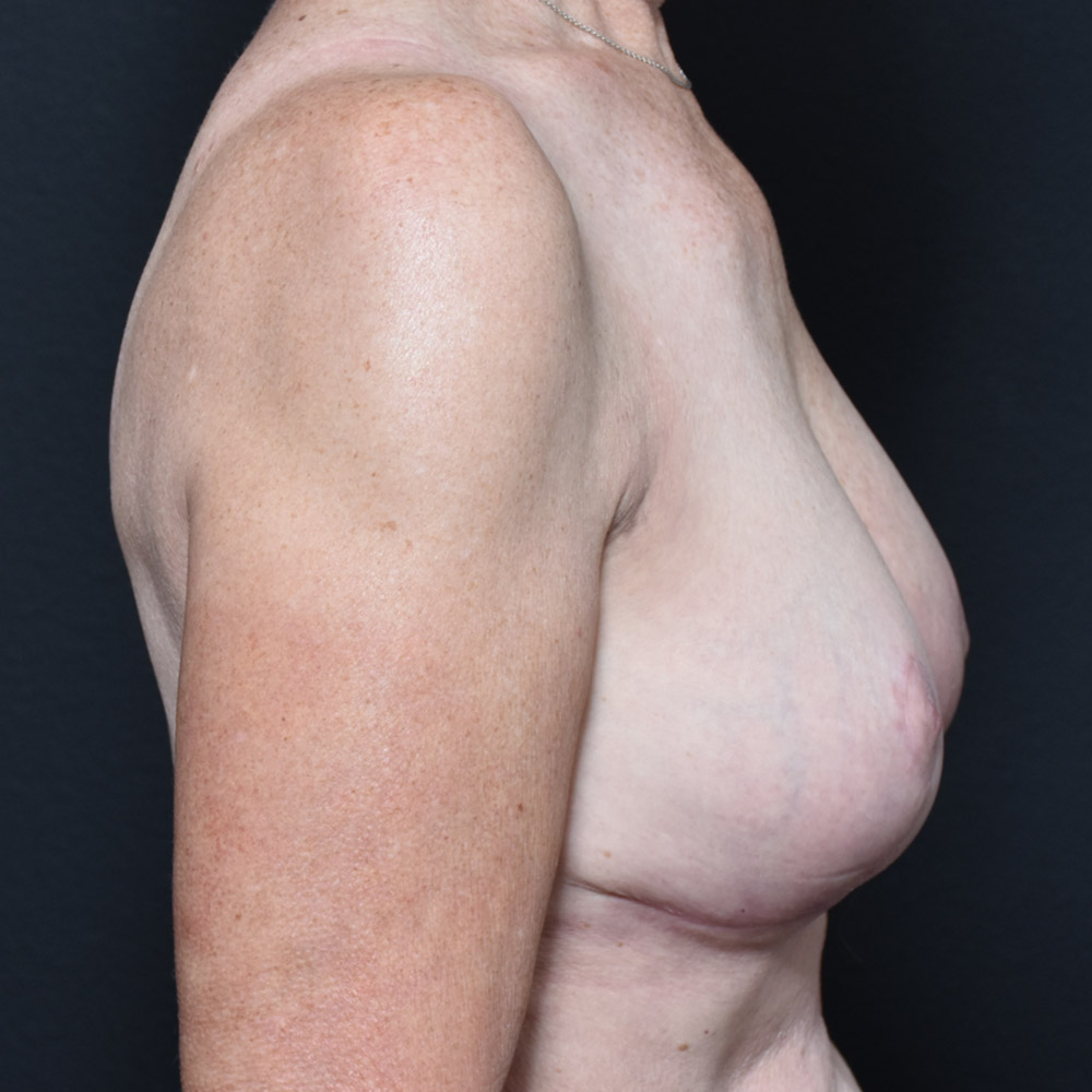 Case--2109 | After Breast Reduction 4