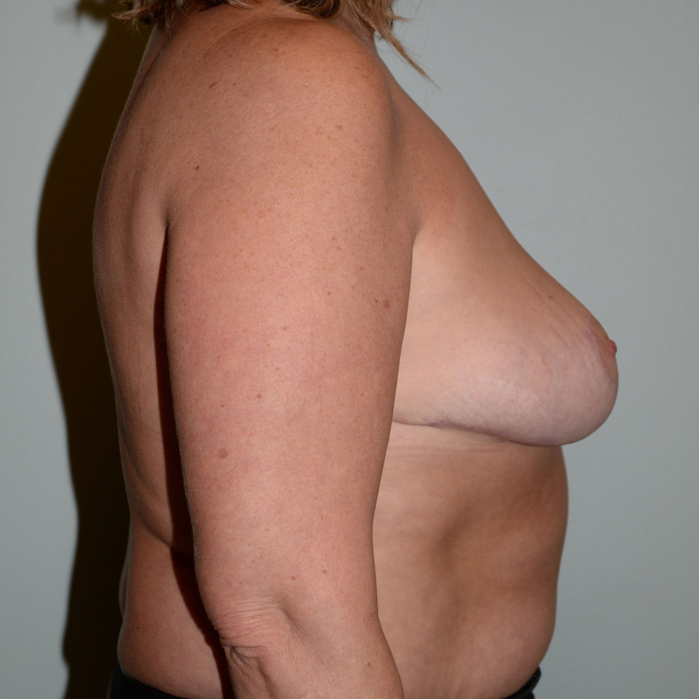 Case--2083 | After Breast Reduction 3