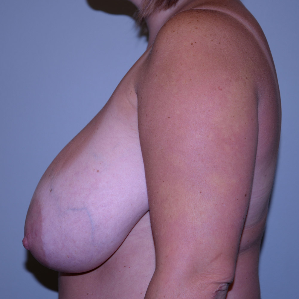 Case--2085 | Before Breast Reduction 2