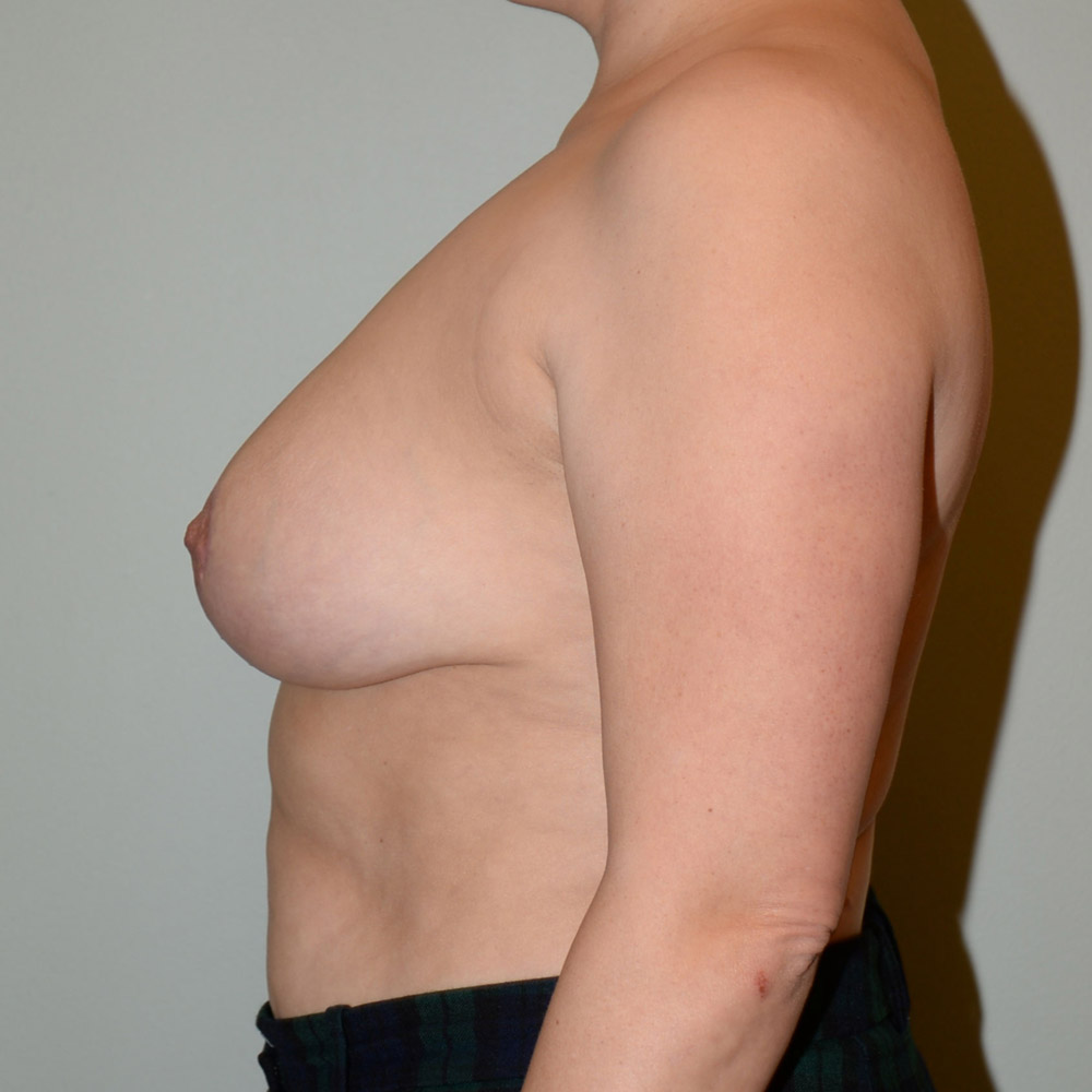 Case--2088 | After Breast Reduction 2