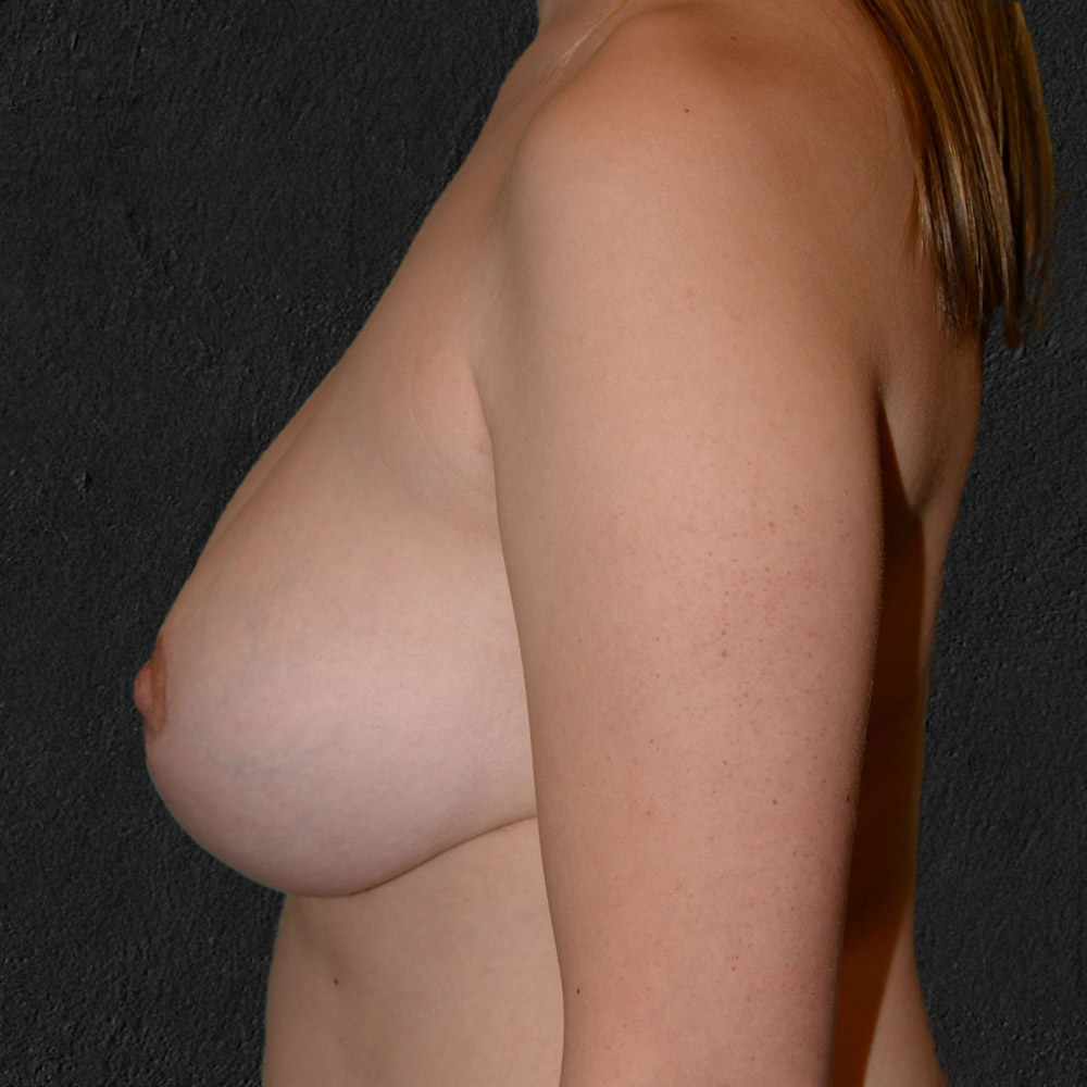 Case--2089 | After Breast Reduction 2