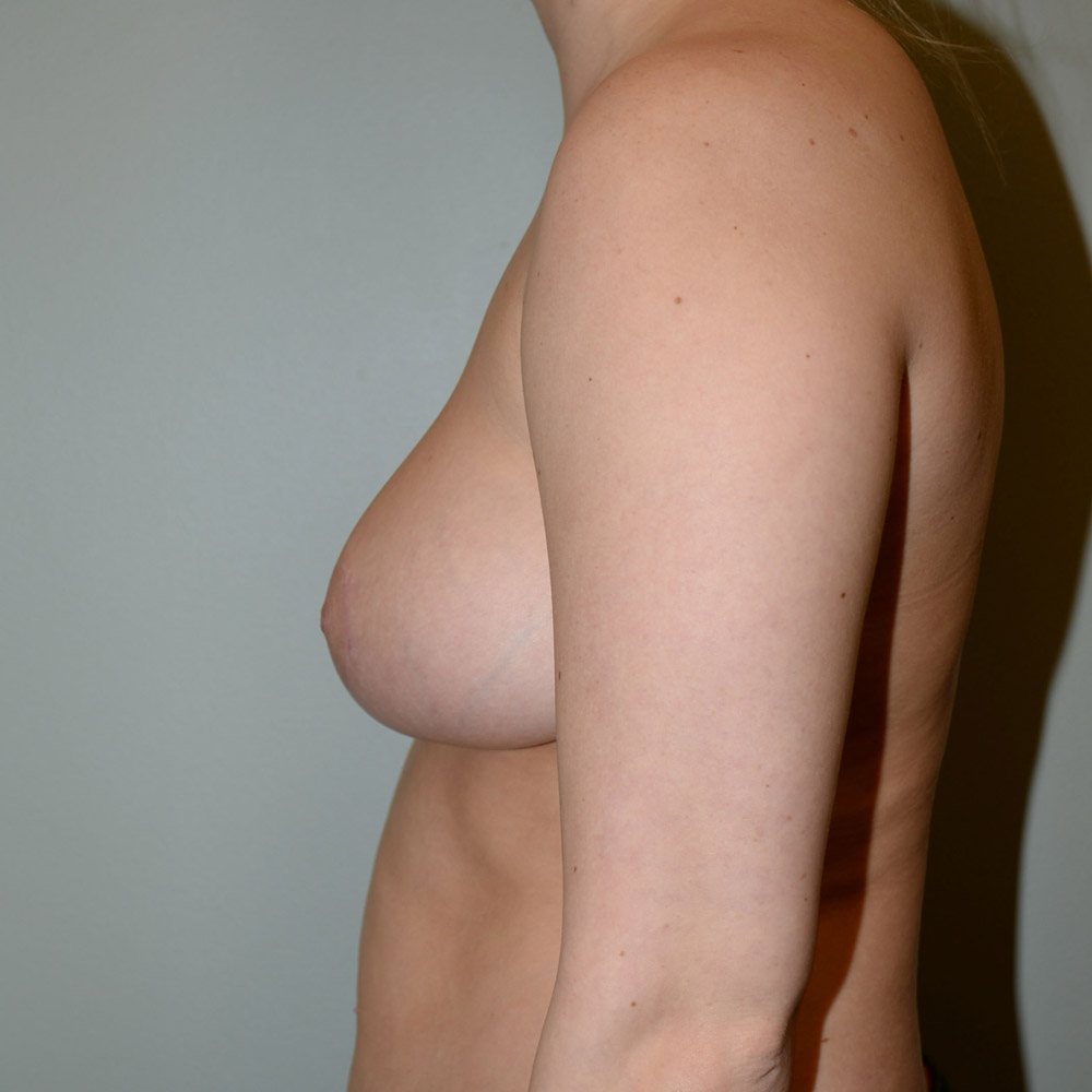 Case--2090 | After Breast Reduction 2