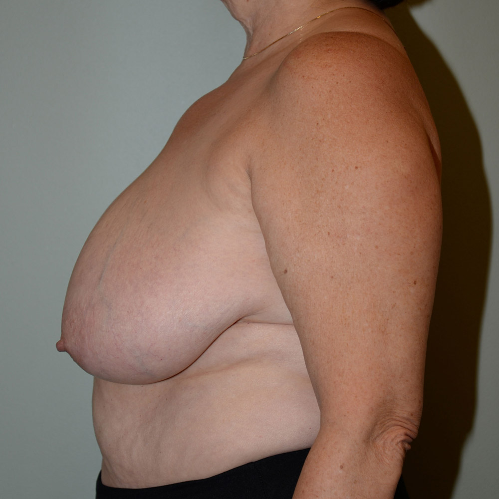 Case--2091 | Before Breast Reduction 2