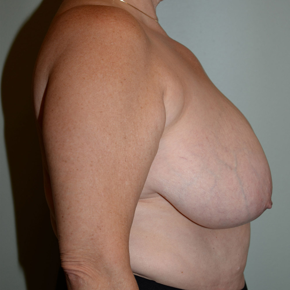 Case--2091 | Before Breast Reduction 3