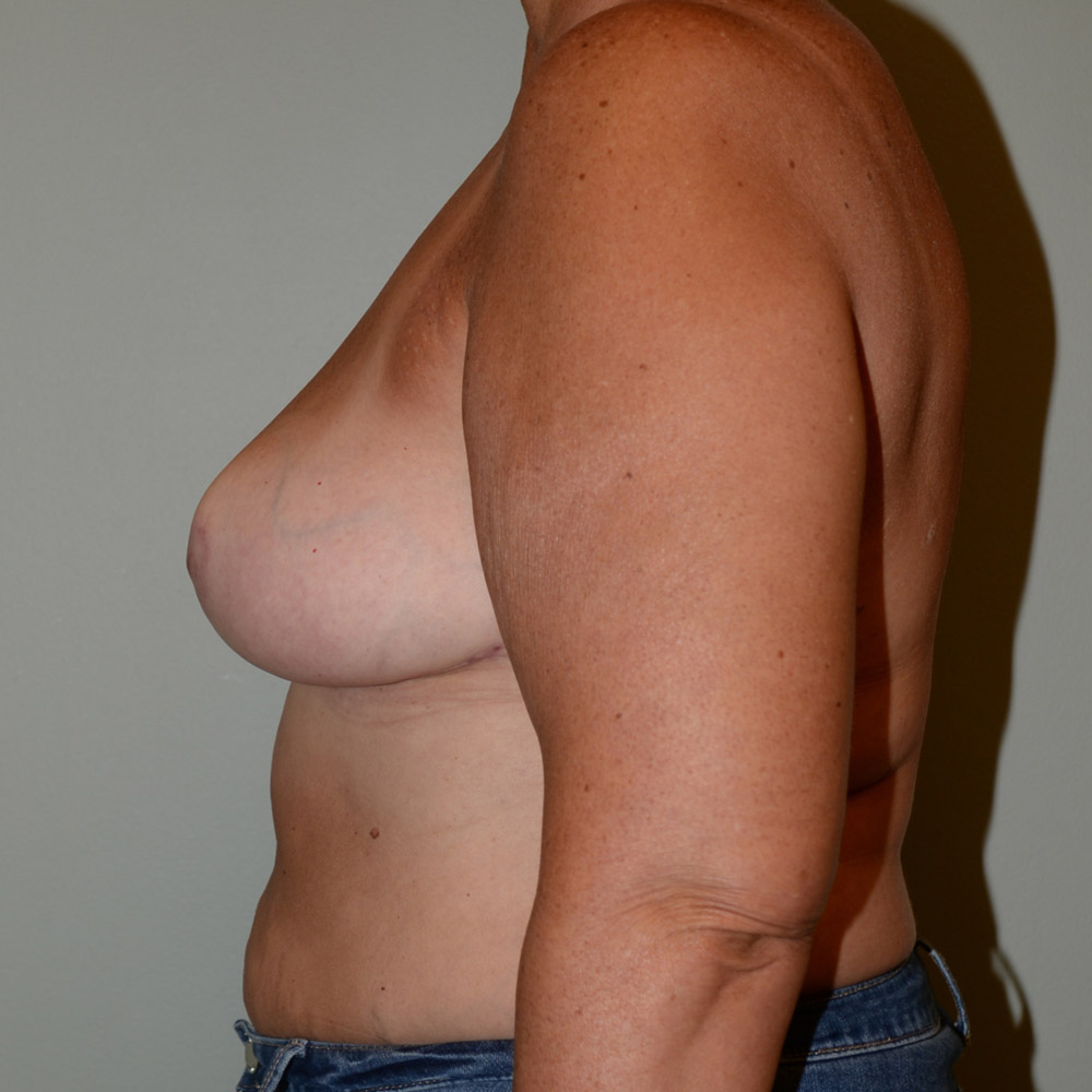 Case--2092 | After Breast Reduction 2