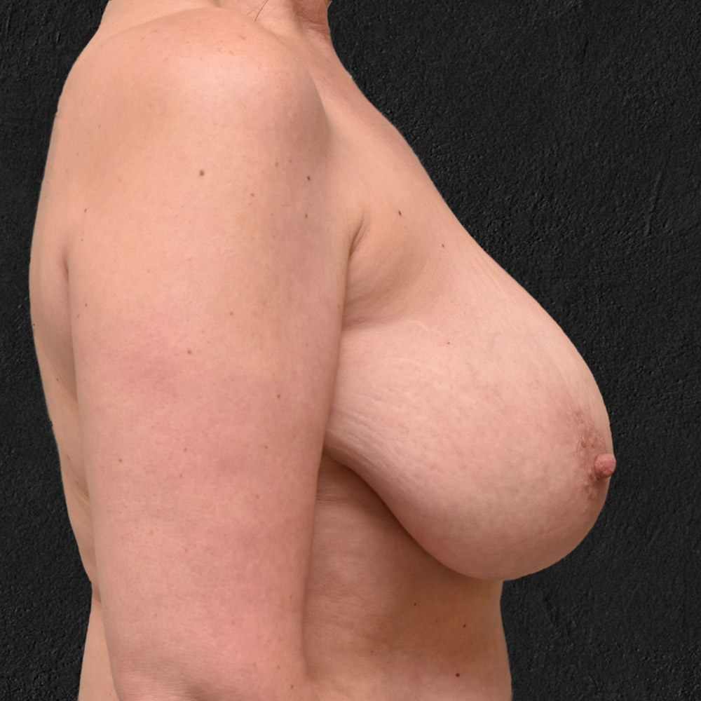 Case--2095 | Before Breast Reduction 3