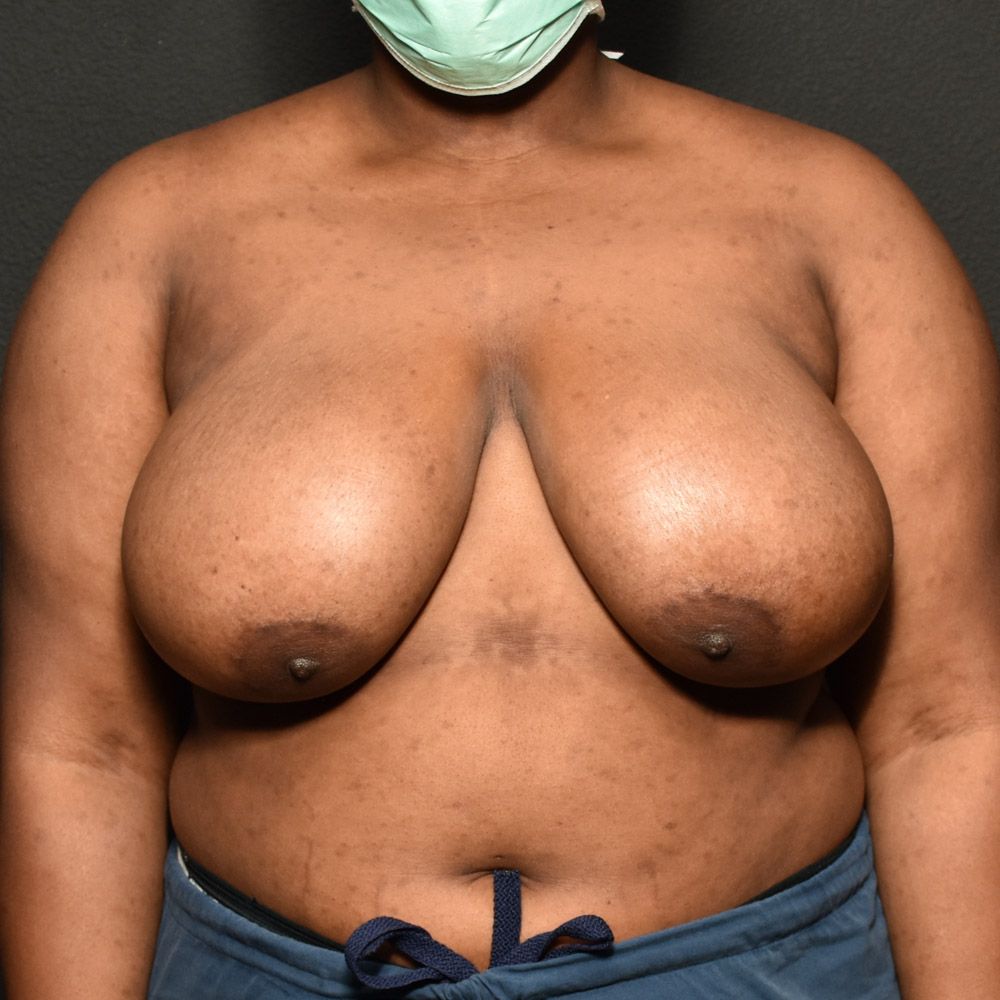 Case--2098 | Before Breast