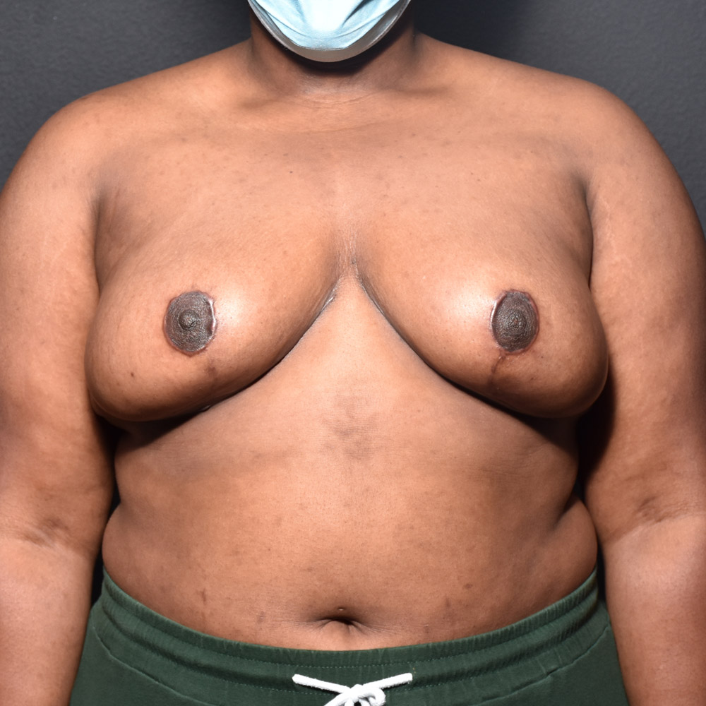 Case--2098 | After Breast
