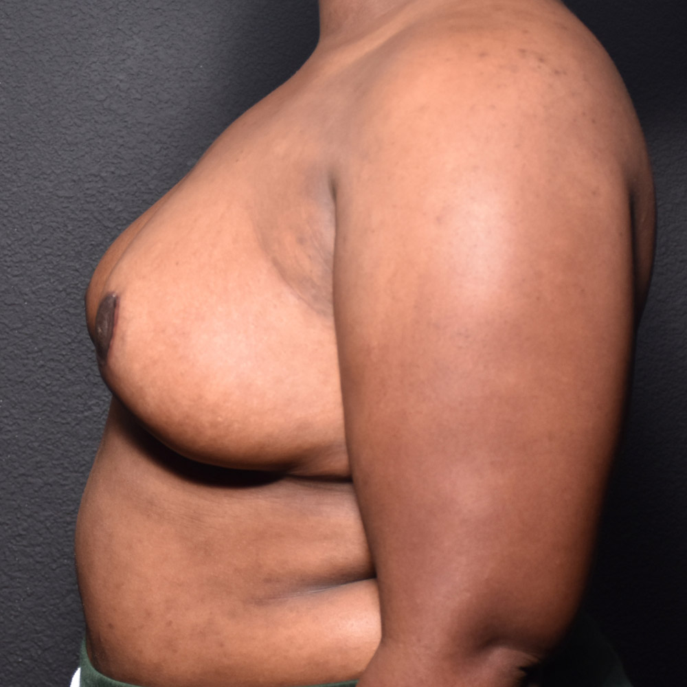 Case--2098 | After Breast Reduction 2