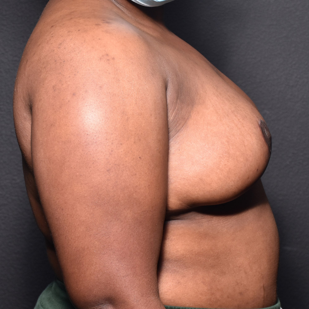 Case--2098 | After Breast Reduction 3