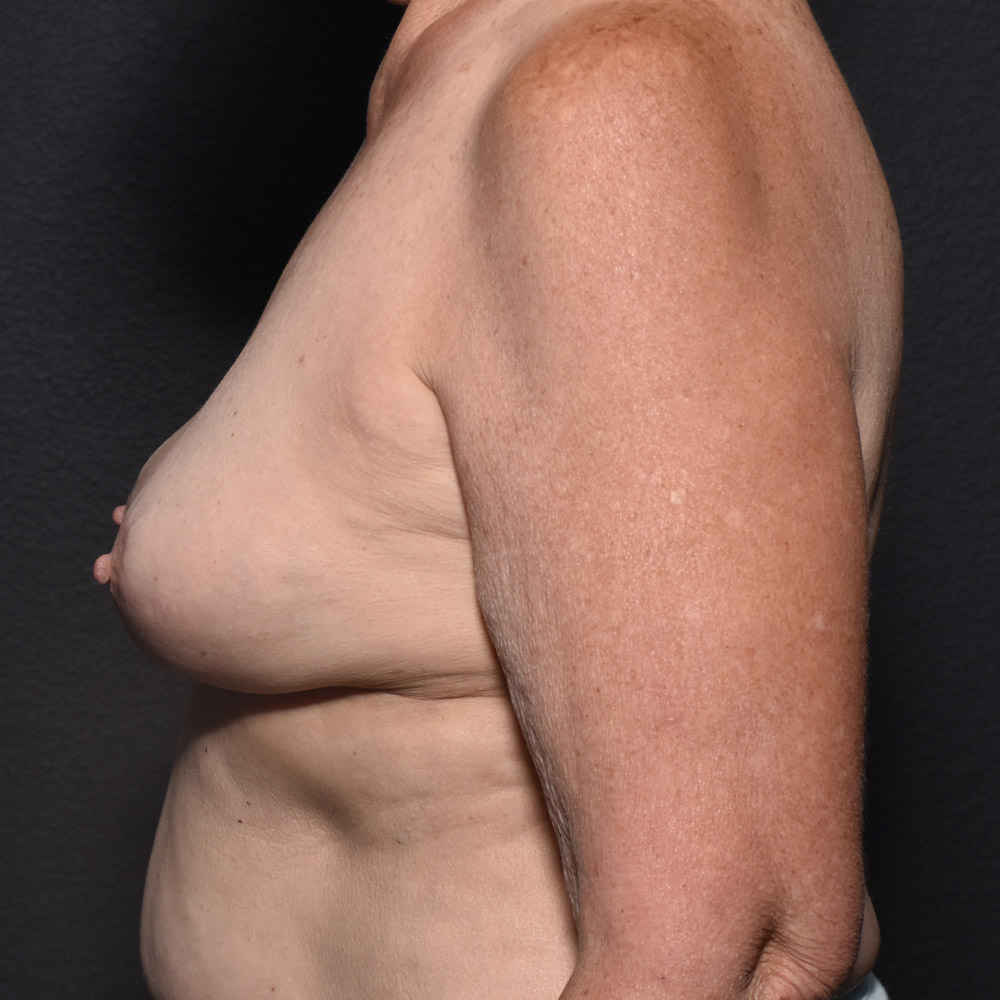 Case--2005 | After Breast Implant Removal or Revision 2