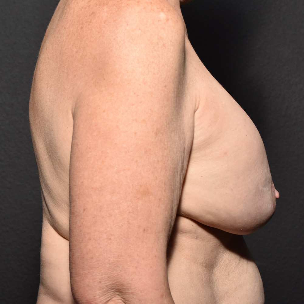 Case--2005 | Before Breast Implant Removal or Revision 3