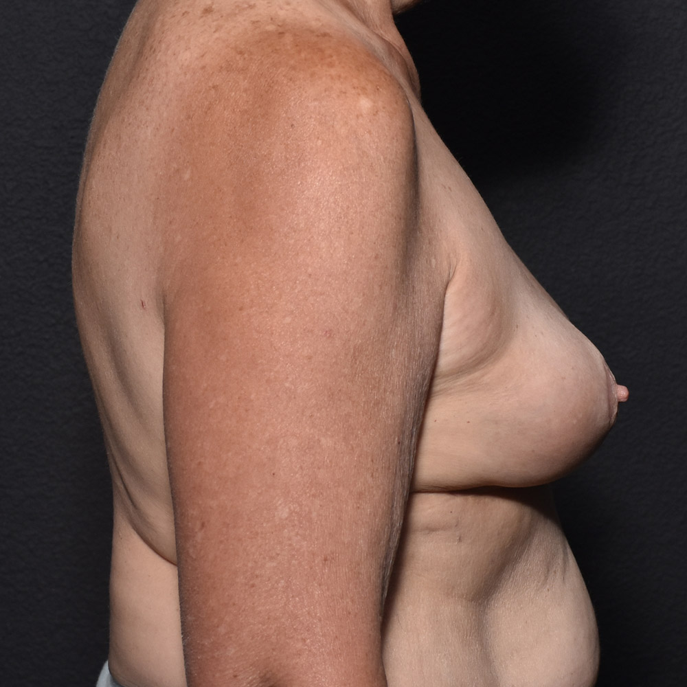 Case--2005 | After Breast Implant Removal or Revision 3