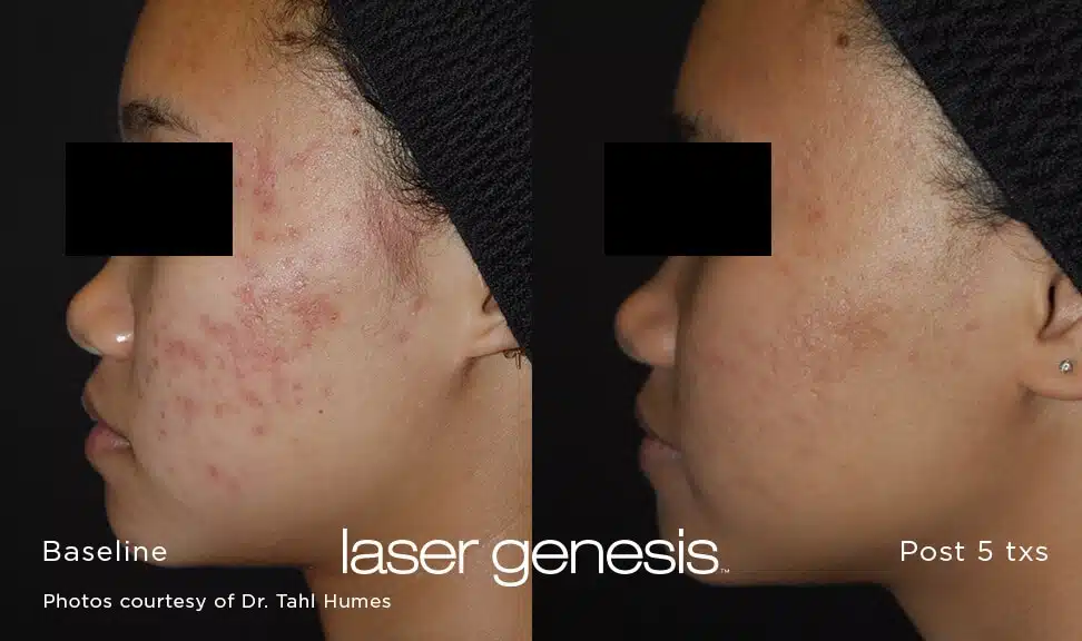 Polyclinic_Cutera_Laser_LaserGenesis_BeforeAfter_2.jpg