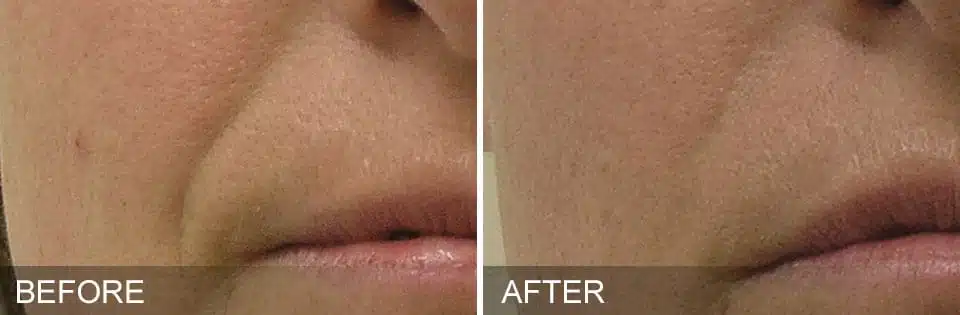 before-after-NasolabialFolds.jpg