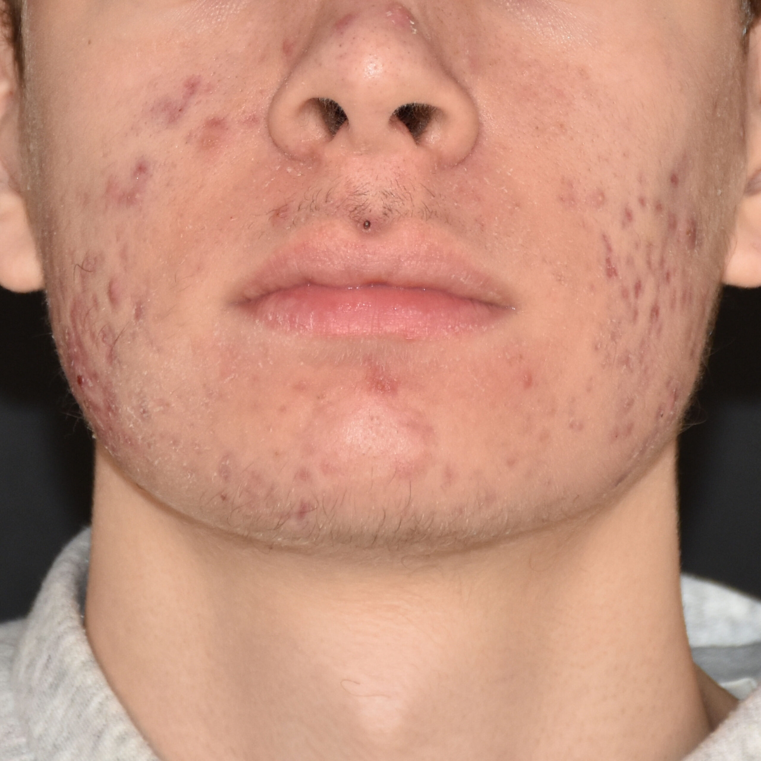 Case--8164 | Before Medspa