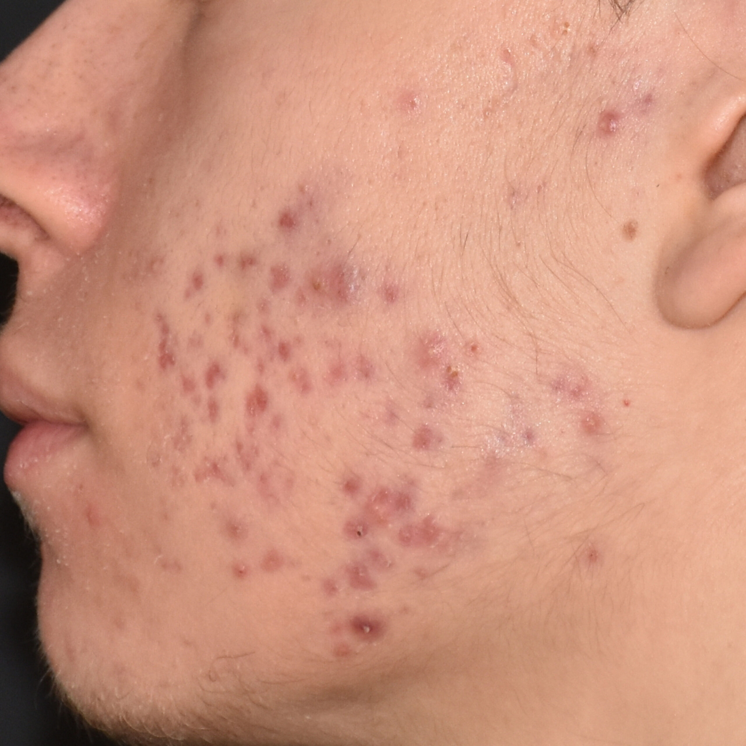 Case--8164 | Before Face Treatments 5